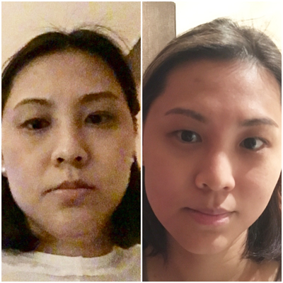 I caught a selfie of my very tired self on the left (in the dark, no less) just before the treatment and there - can you see the double chin? The one on the right is after one session of Endermolift and it's considerably more contoured